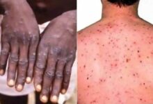 Monkey Pox Alert in UP: The threat of monkey pox has increased in Uttar Pradesh, after which the Yogi government has issued a warning