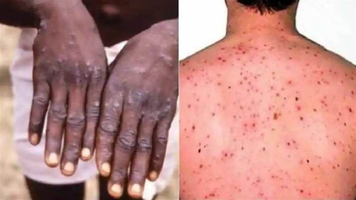 Monkey Pox Alert in UP: The threat of monkey pox has increased in Uttar Pradesh, after which the Yogi government has issued a warning